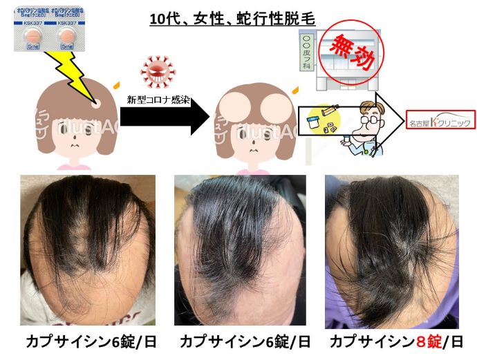 円形脱毛症　病院
